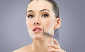 Acne Scars Treatments